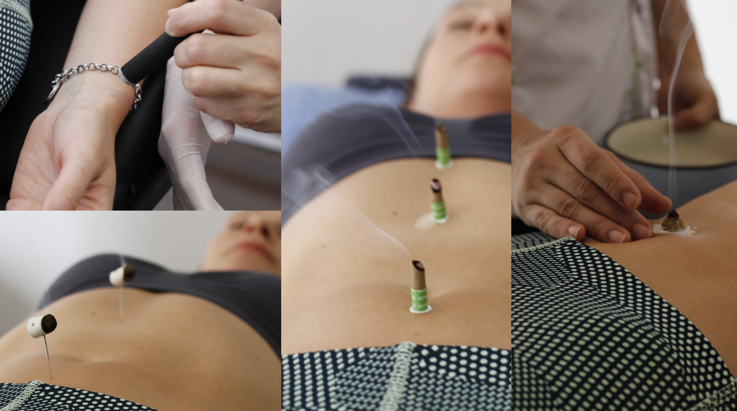 Esta estimulación con calor tenue puede utilizarse como apoyo en los tratamientos con acupuntura